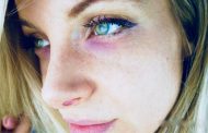 Microneedling gegen Augenringe: Lohnt es sich?
